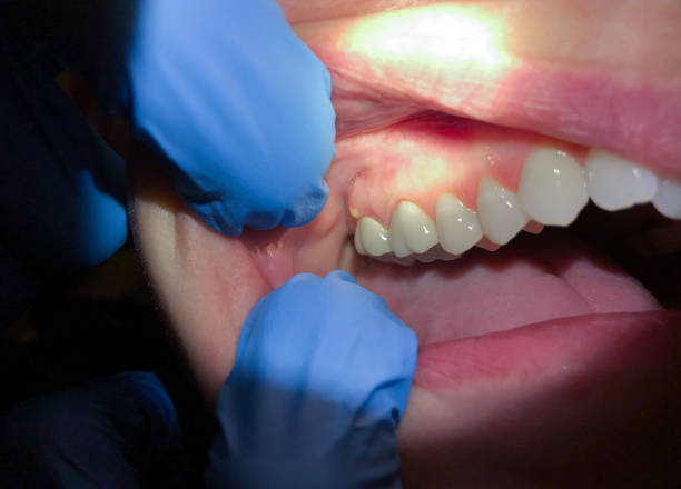 Best Emergency Treatment for Dental Infections or Abscesses in Hebron, IN